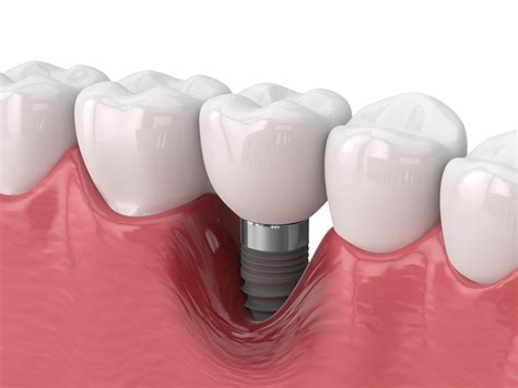 aspen dental rochester mn|Dental Implants in Rochester, MN